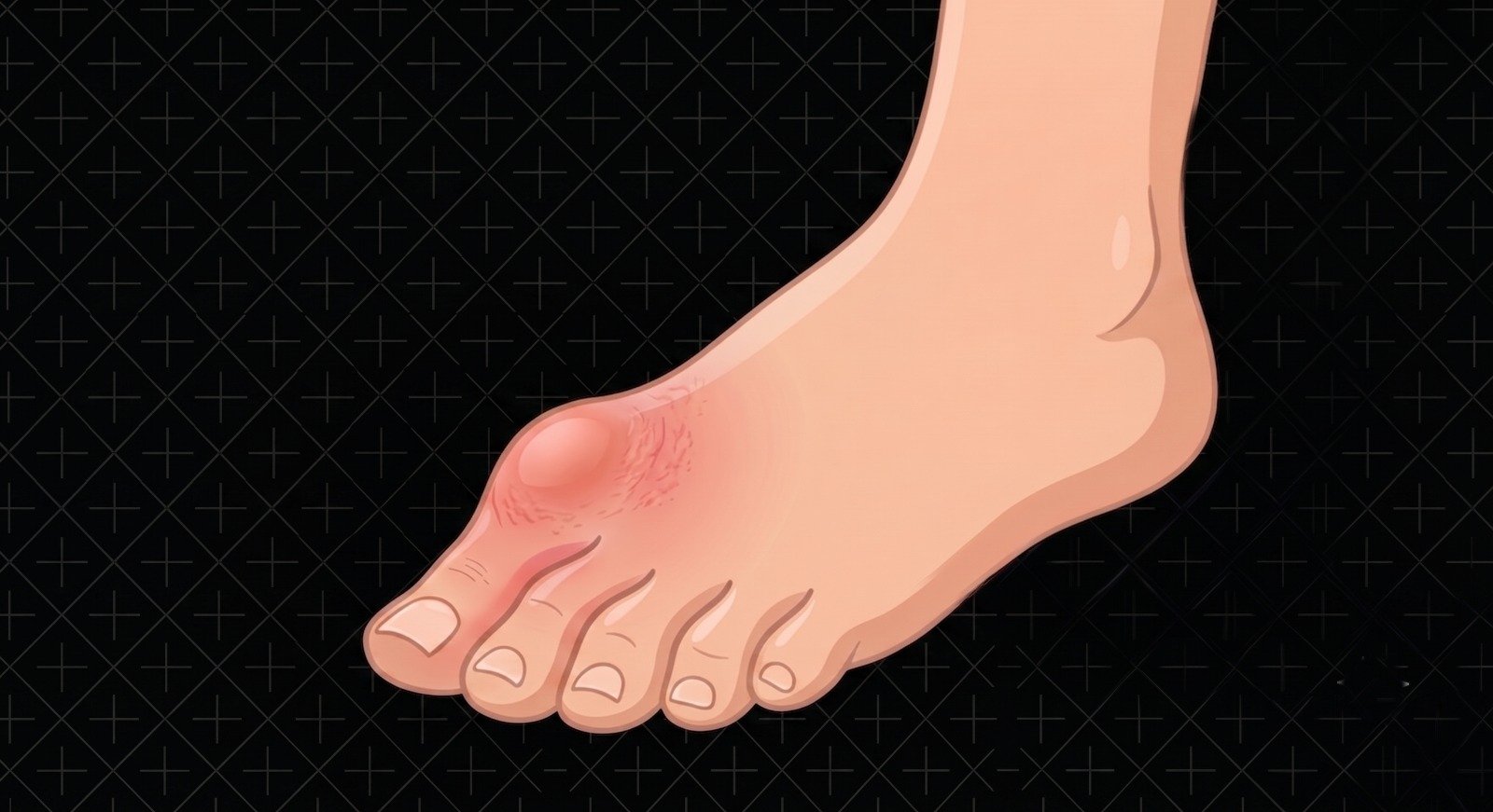 Fascial Inflammation
