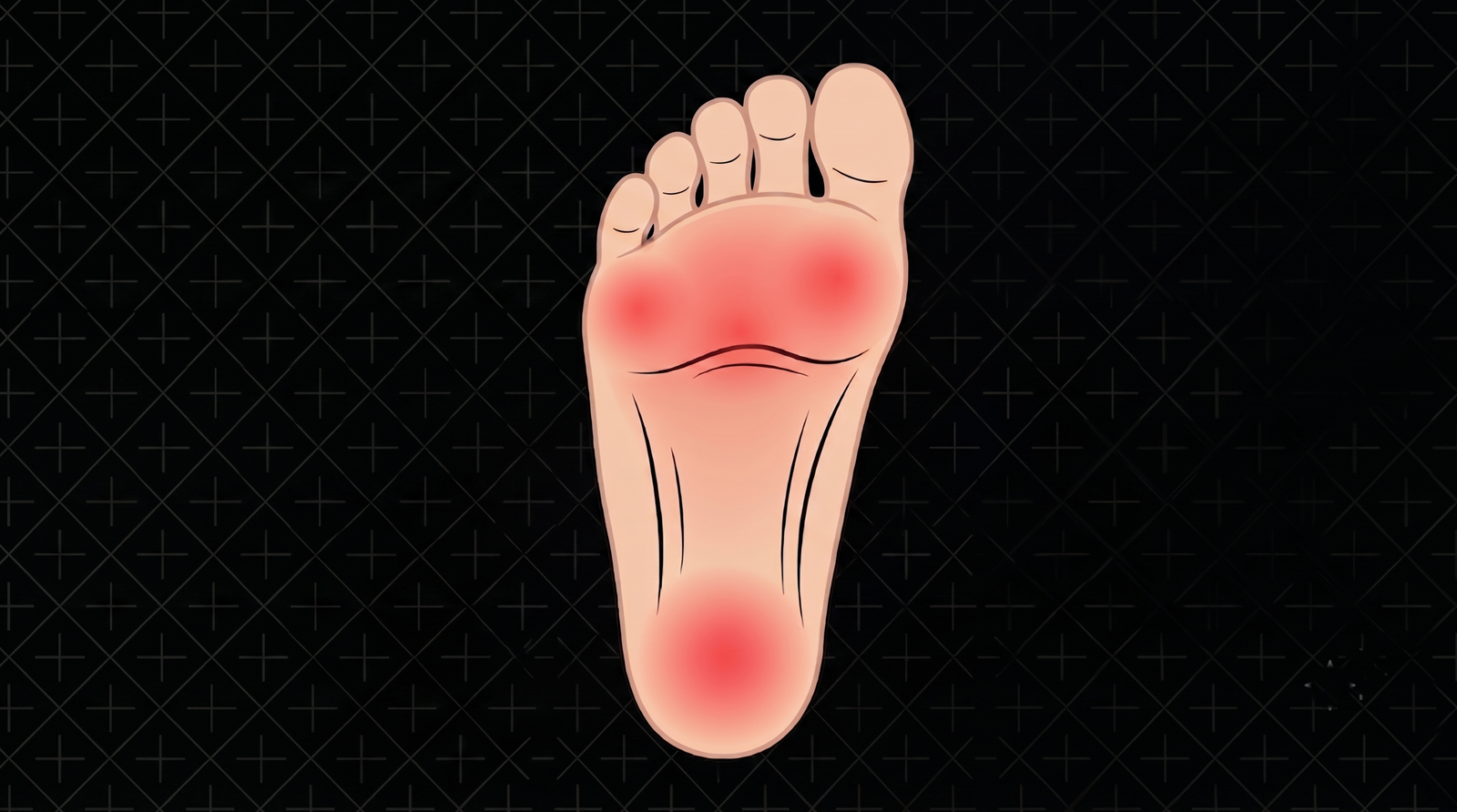 Plantar Arch Strain